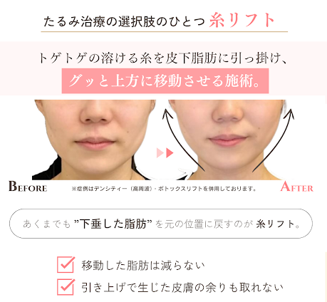 糸リフトの施術原理と効果を最大にするための方法を美容ドクターが解説