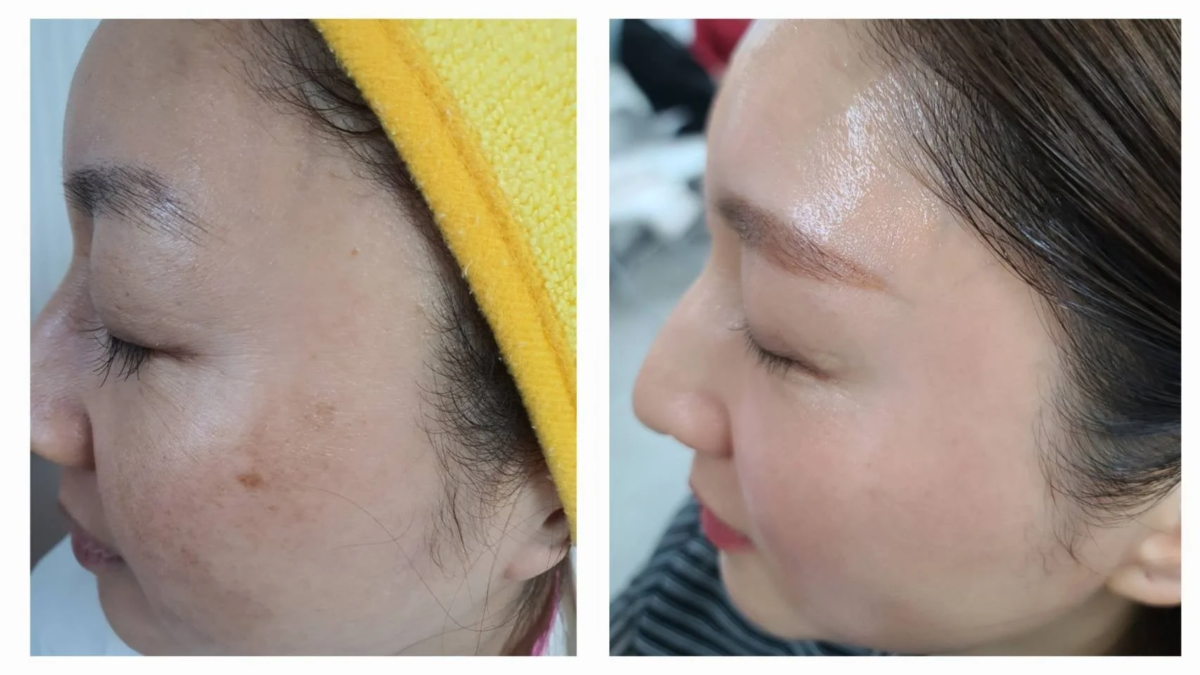 インセルダム使用後の肌の変化