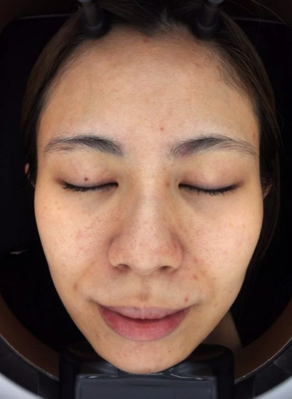 スタッフH 10日間後の肌変化