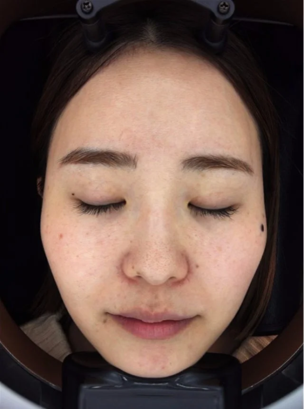 スタッフK 10日間後の肌変化