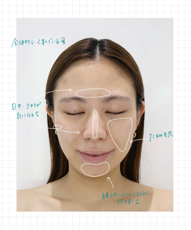 スタッフHの肌悩み