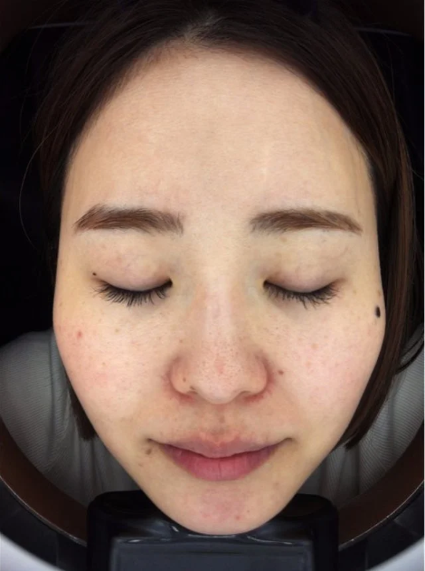 スタッフKのチャレンジ後肌状態2