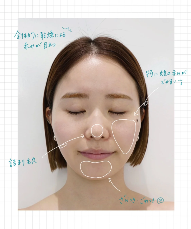 スタッフKの肌悩み