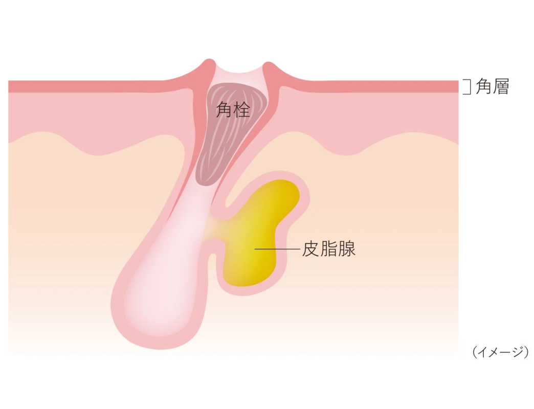 毛穴が角栓で詰まり、皮脂腺が隣接している皮膚の断面図