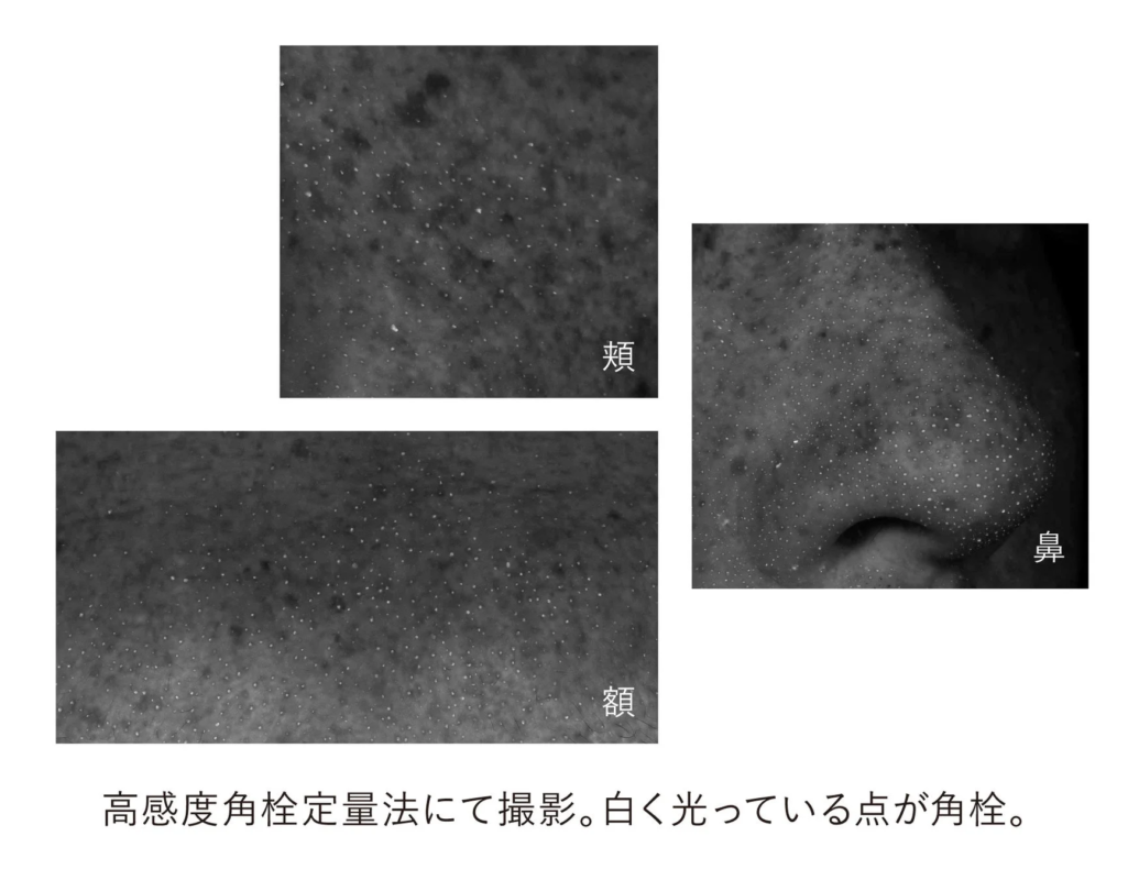 頬、額、鼻の拡大画像。白く光る点で示された角栓の状態