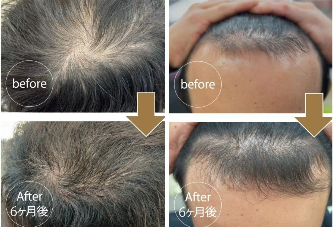 60代男性モニター様 before After 6ヶ月後