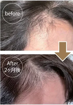 50代女性モニター様 before After 2ヶ月後
