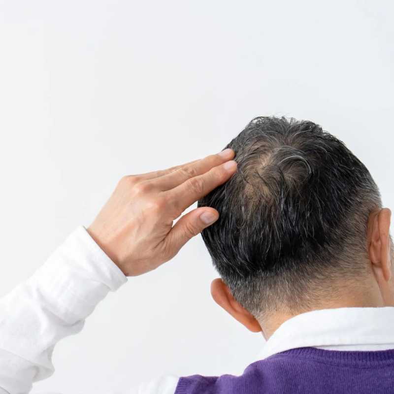 中高年男性が後頭部の薄毛や抜け毛を気にしている様子