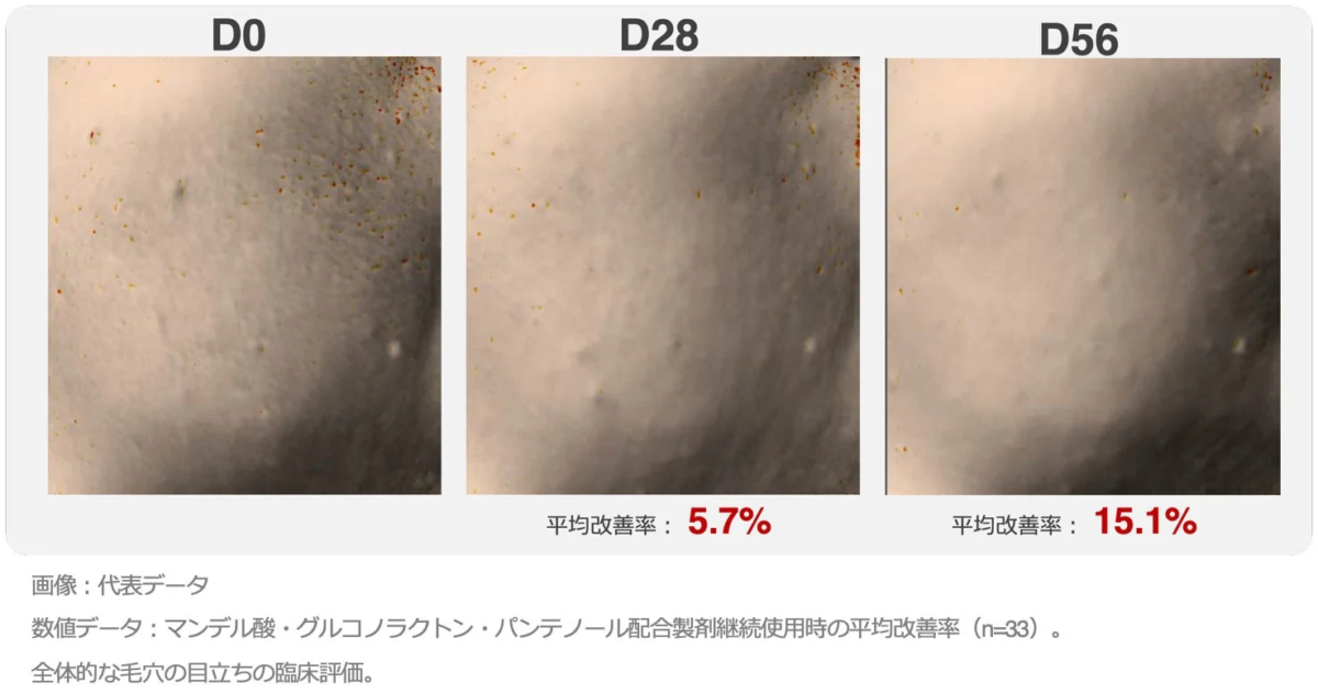 マンデル酸、グルコノラクトン、パンテノール配合製剤使用による毛穴の目立ち改善を示す臨床評価画像